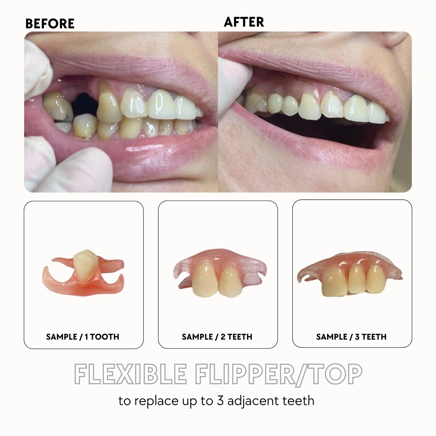 5 Reasons Why Flipper Teeth Are a Game-Changer for Missing Teeth ...