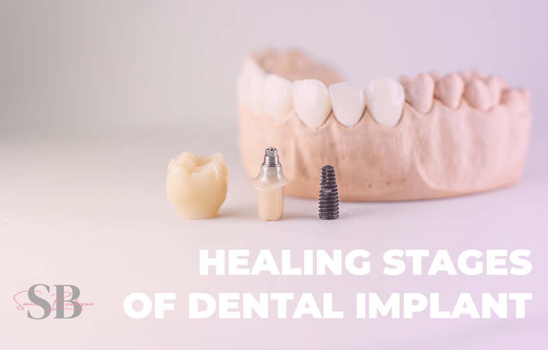 The healing stages of dental implant