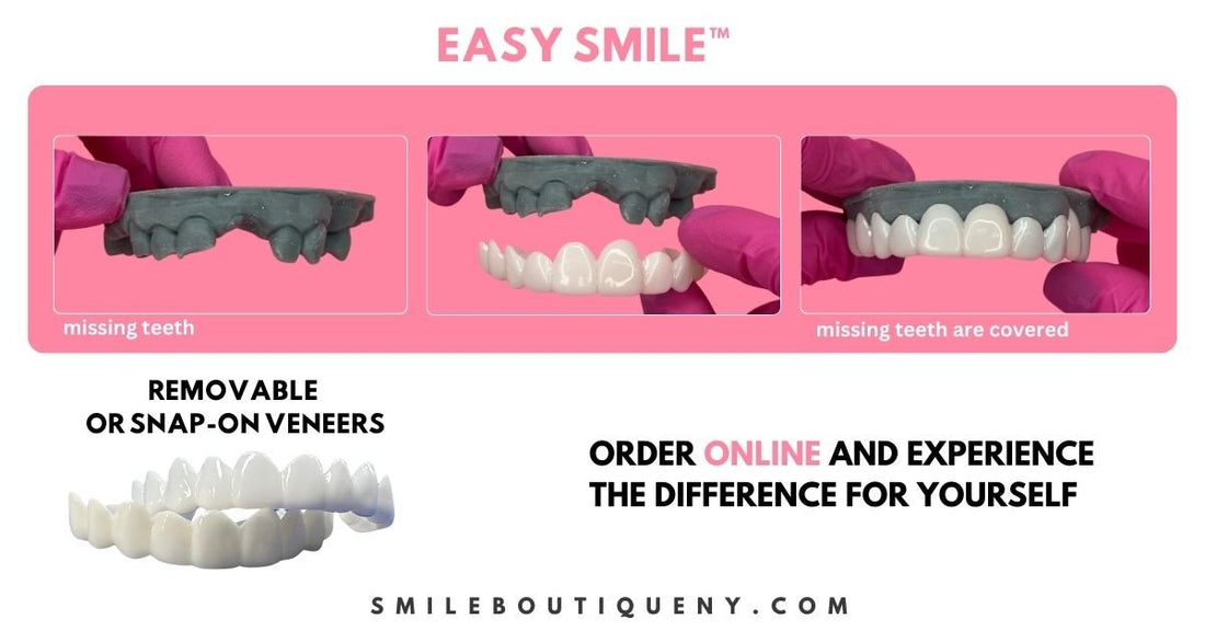 The Smile Revolution: Snap-On Veneers vs. Traditional Veneers – A Comprehensive Comparison - Smile Boutique NY