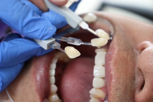 What is Dental Veneer: All You Need to Know