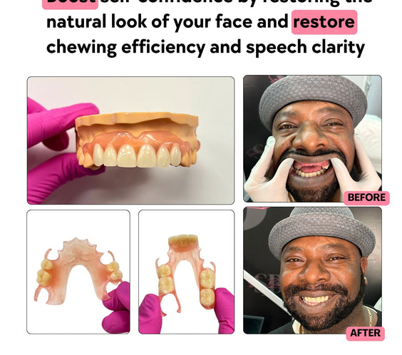Flexible Partial Denture