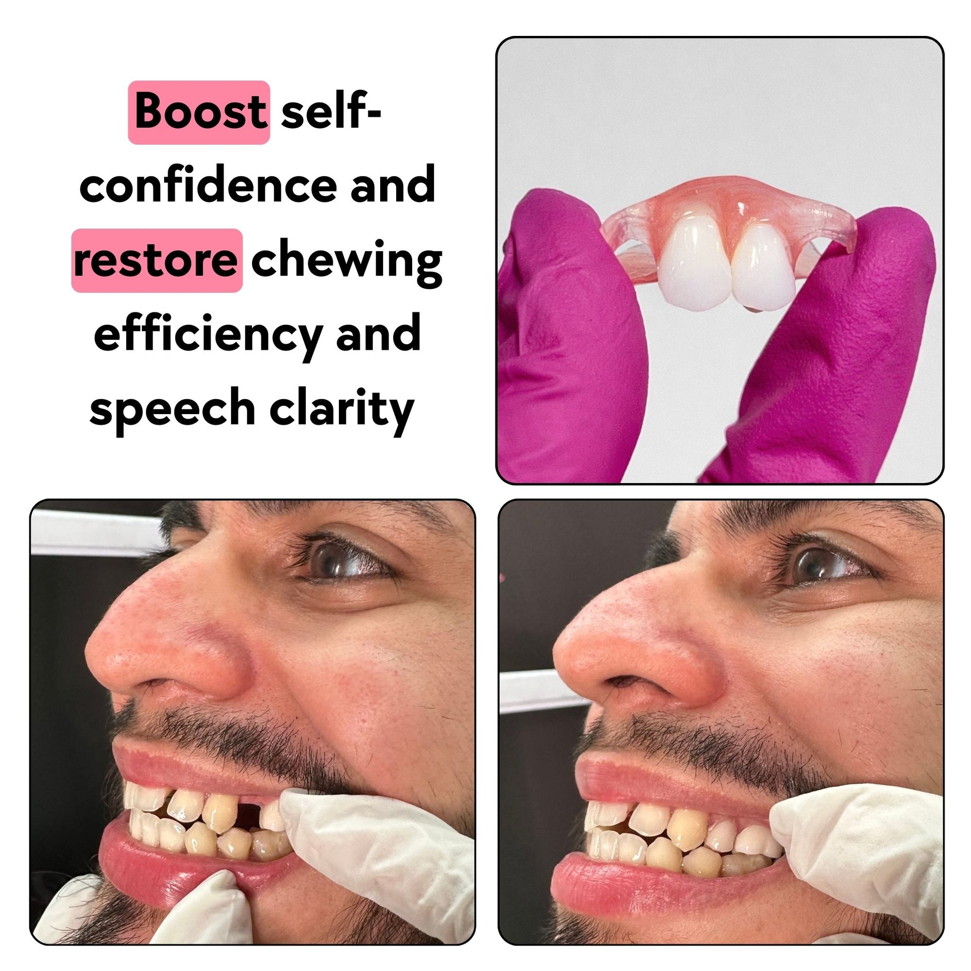 Semi Flex Flipper for up to 2 adjacent teeth