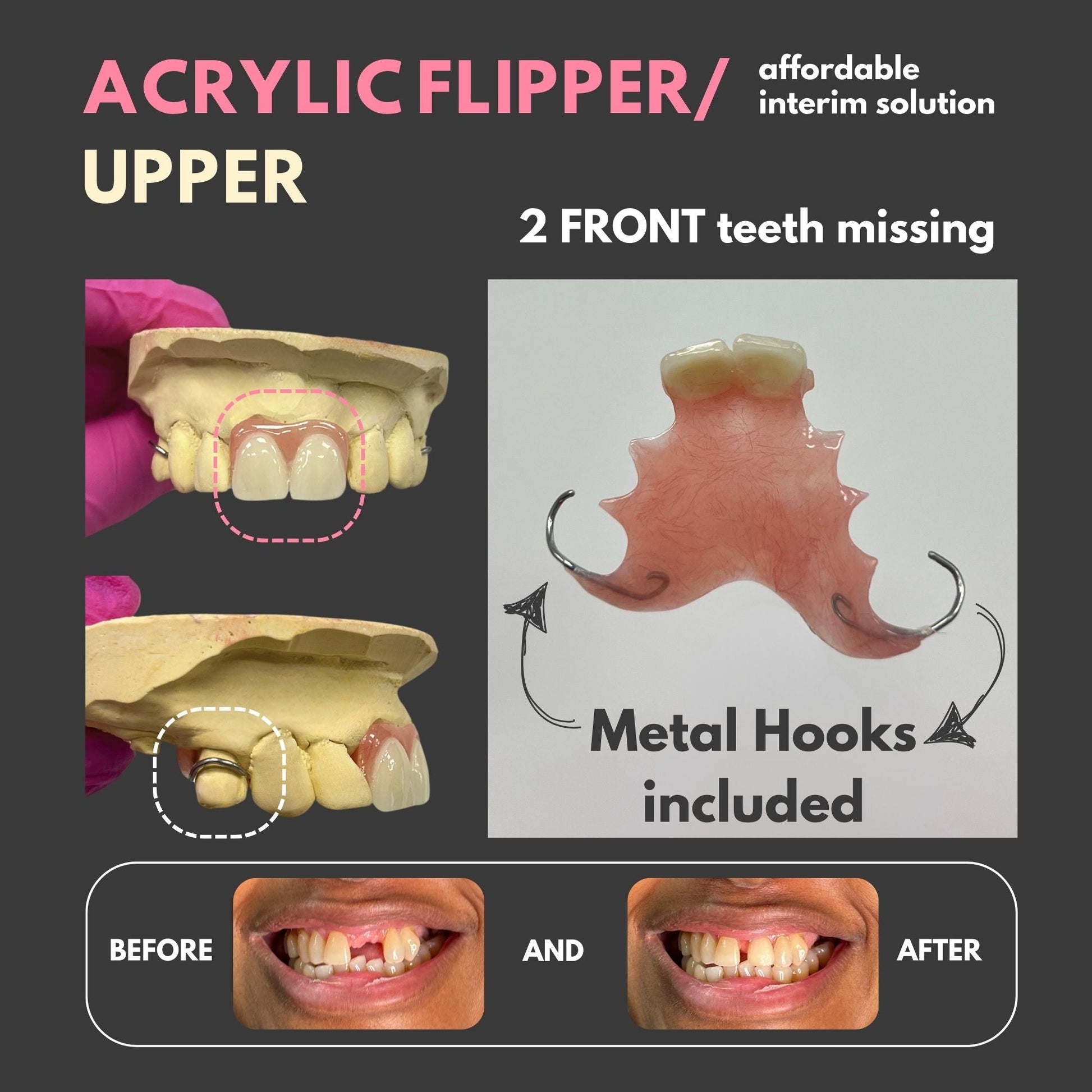 Acrylic Flipper for up to 3 Teeth Dental Solution – Smile Boutique NY
