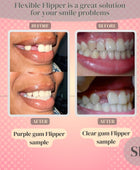 Flexible Flipper (up to 3 teeth) - Smile Boutique NY