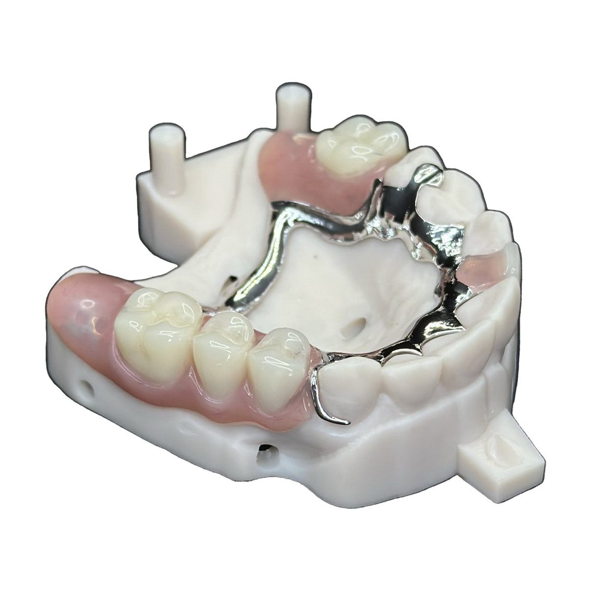 OUR PRINTED METAL PARTIAL DENTURE